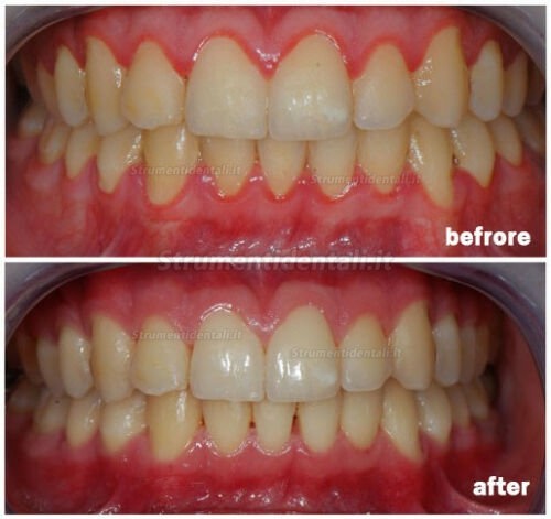 Penna laser a diodi in odontoiatria 400μm